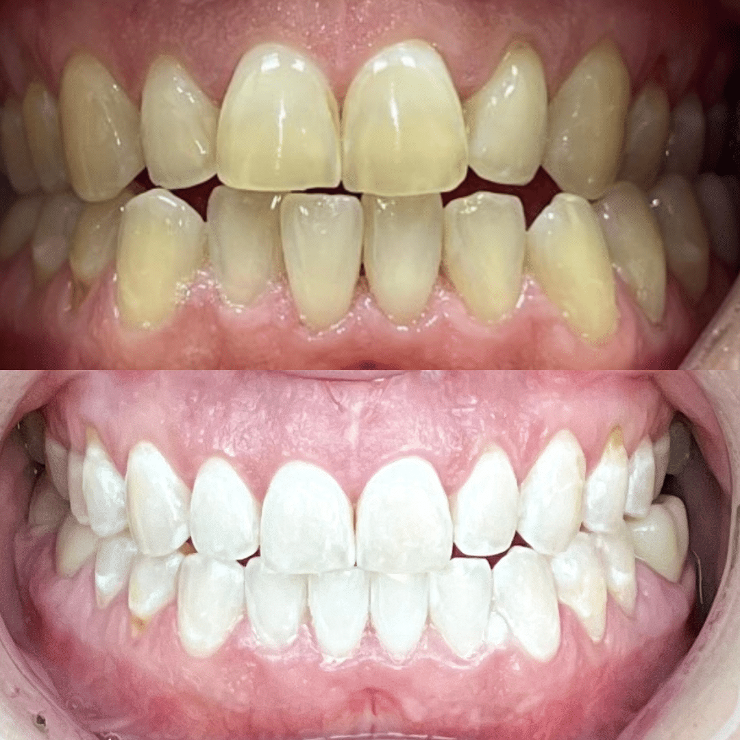 Smile Dental Vegas before and after photos