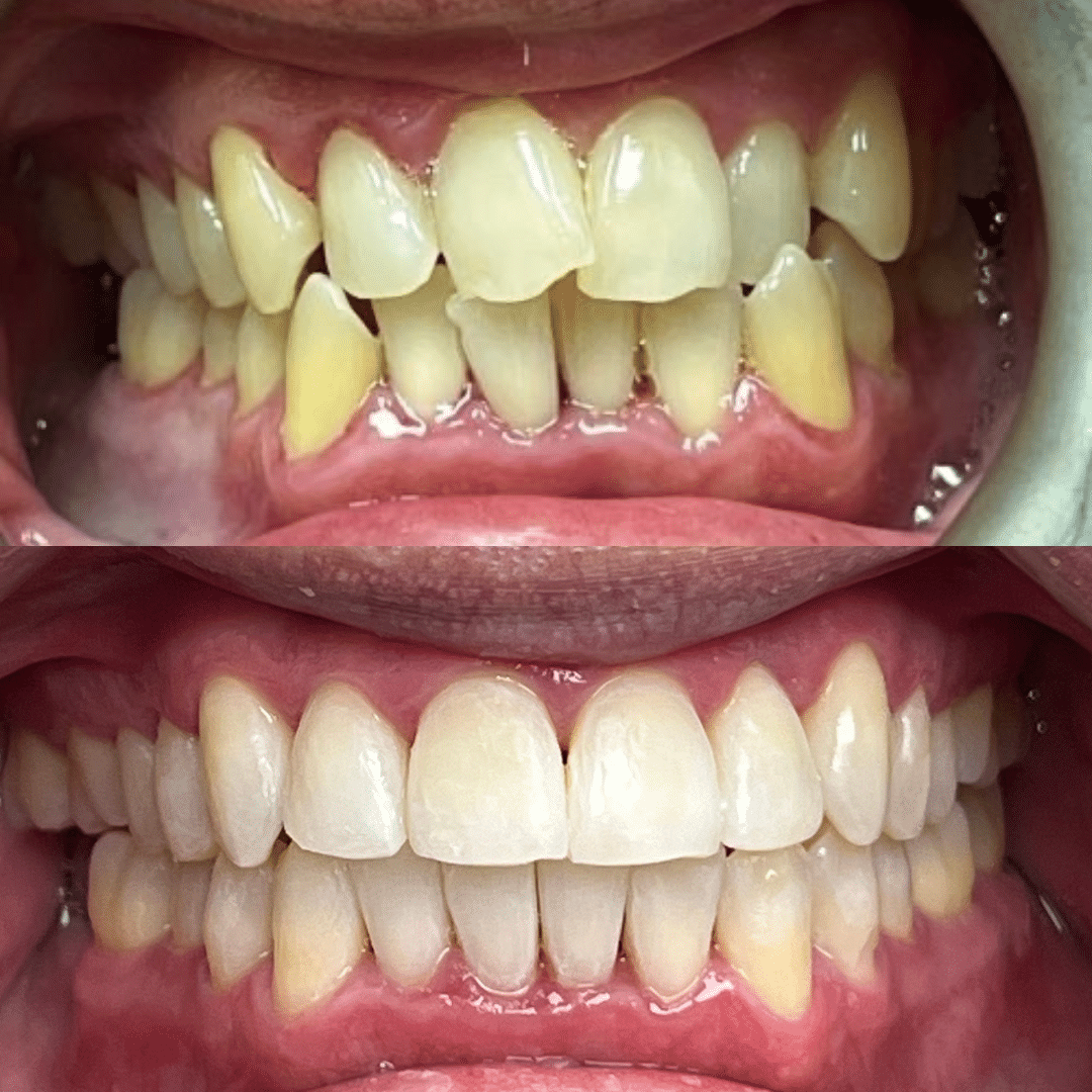 Smile Vegas Dental Before and After Photo 4