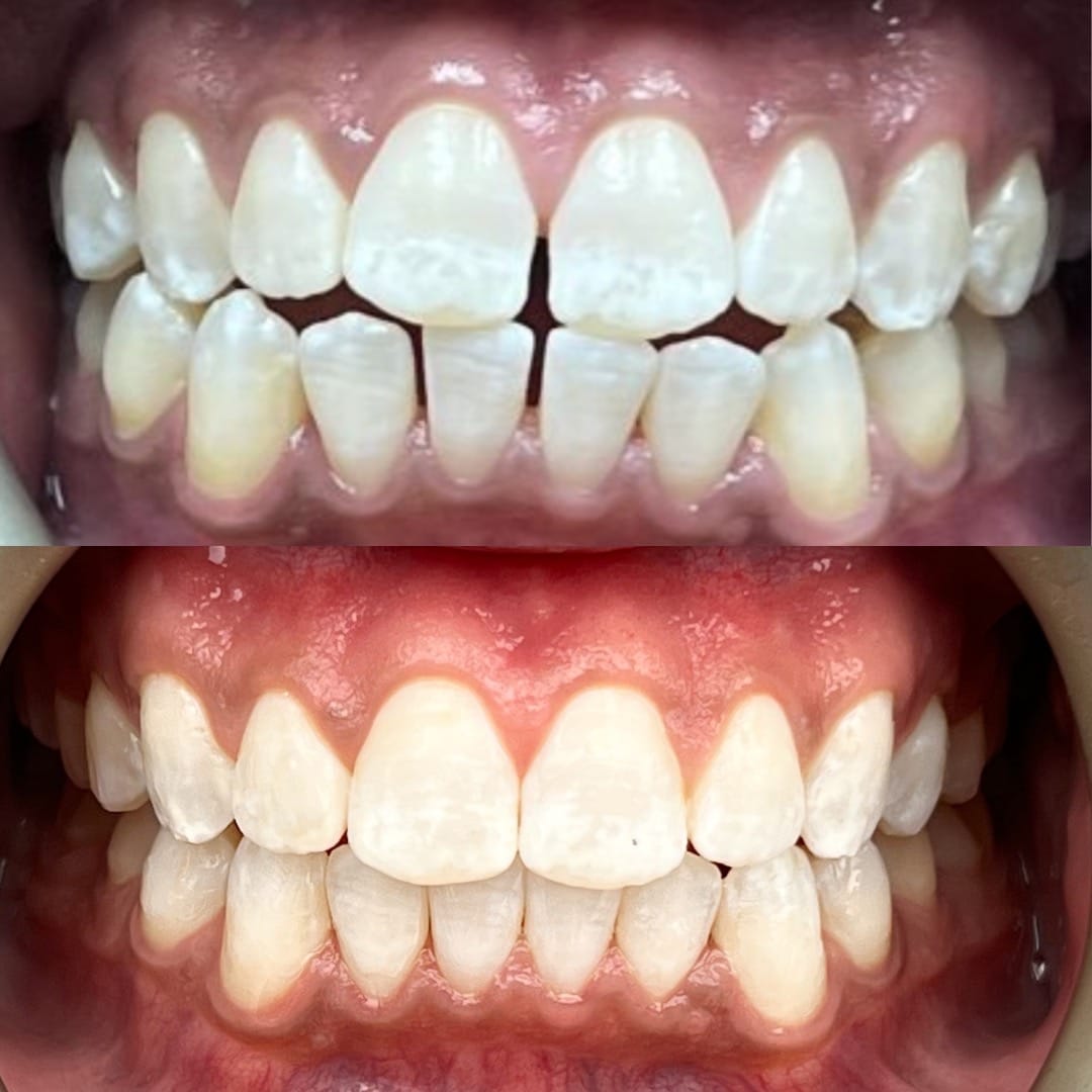 Smile Dental Vegas Before and After photos 2