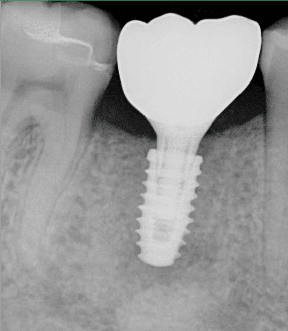 Smile Vegas Dental Implant Final Image