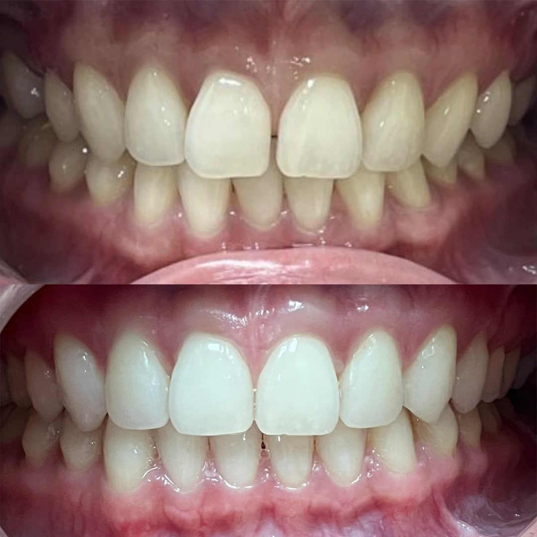 before and after shots of teeth transformation