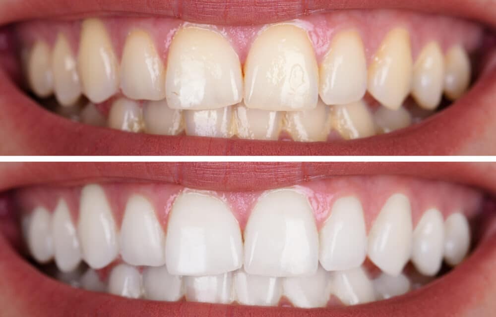 Smile Confidently: Discover Effective Teeth Whitening in Las Vegas