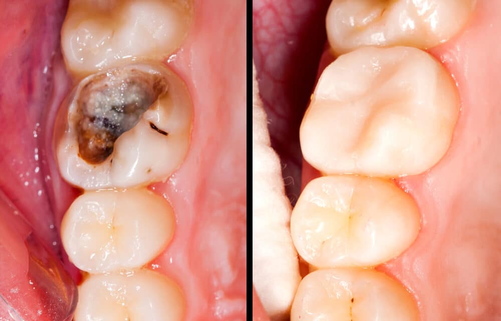 Dealing with Decay: How Long Can a Dead Tooth Stay in Your Mouth?