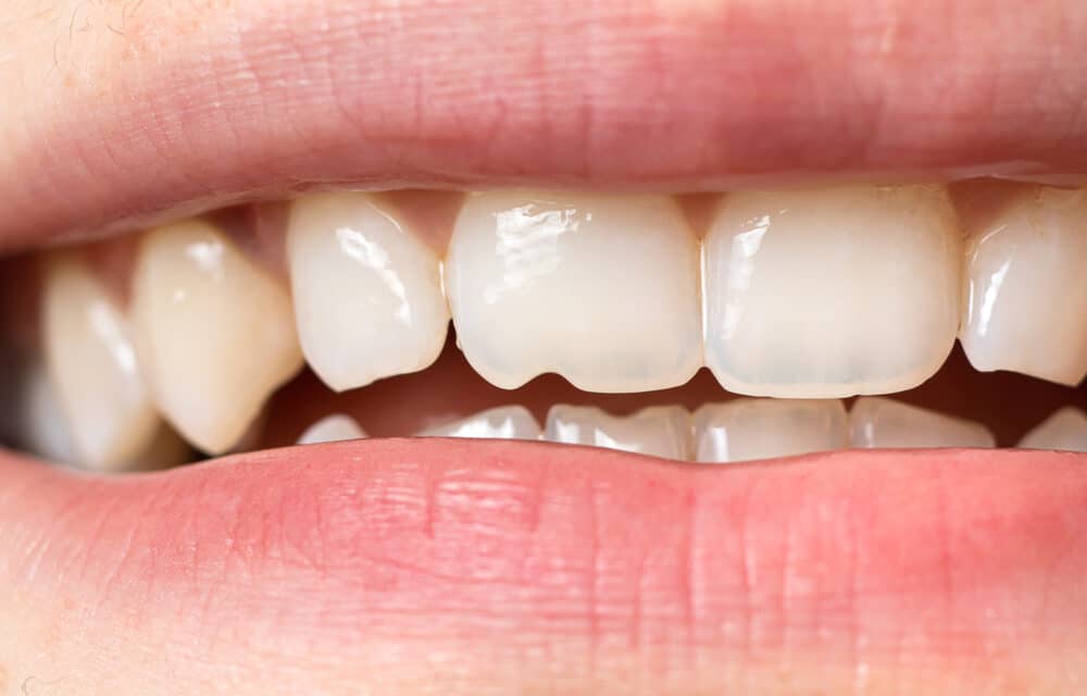 Chipped Tooth Woes: Can a Chipped Tooth Grow Back?