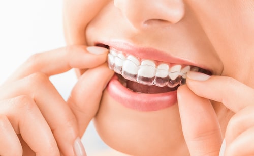 Straightening Your Smile with Las Vegas Invisalign