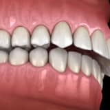 Overbite treatment in Las Vegas with Smile Dental Vegas