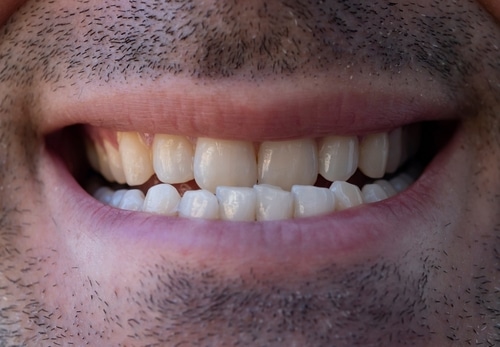 Underbites Unmasked: Understanding and Treating Your Smile