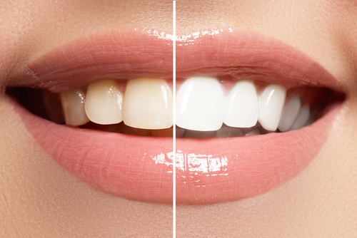 Illuminate Your Smile: A Guide to Las Vegas Teeth Whitening Options