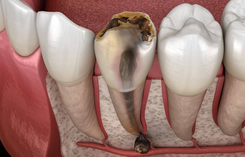 How to deal with an Infected Root Canal