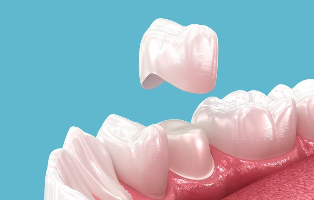 Is a Dental Crown Really Necessary? Exploring Your Options